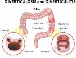 Image result for Small Intestinal Bleeding