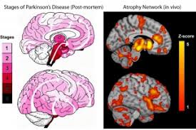 Occasionally, your doctor may suggest surgery to regulate certain regions of your brain and improve. New Study Maps The Progression Of Parkinson S Disease Within The Brain Channels Mcgill University