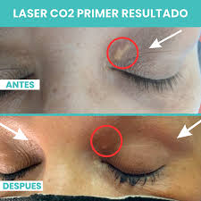 Image result for xantelasma