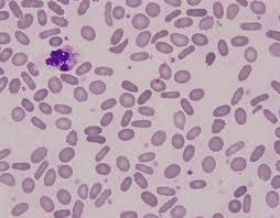 Image result for Peripheral Smear