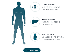 The symptoms of ulcerative colitis vary from person to person and about half of all ulcerative colitis patients experience mild symptoms. Pulsenotes Ulcerative Colitis Notes