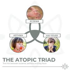 Image result for Allergic Triad