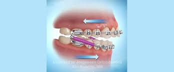 While there's no official upper limit for braces, your oral health can decline with age. Kiss Your Overbite Goodbye With Forsus Springs Affordable Braces Jorgensen Orthodontics