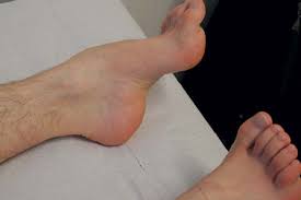 Consult a doctor for medical advice. Https Www Thieme Connect Com Products Ejournals Pdf 10 1055 A 0925 1719 Pdf