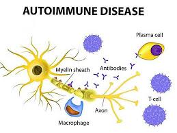 Forme primarie (circa 80% del totale) e forme secondarie(20%).in entrambe le forme la natura della malattia sembra essere di tipo autoimmune e si. Malattie Autoimmuni Cause E Sintomi It Odysseedubienetre Be