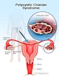 Common signs and symptoms of pcos can include Polycystic Ovarian Syndrome Pcos Symptoms Pregnant Causes Treatment