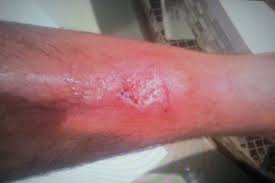Due to sudden flow of blood and if left untreated, camel spider bite can lead to an infection. Ufc S Stephan Bonnar Bitten By Giant Camel Spider While Detained By Bahrain Airport Security Mmamania Com