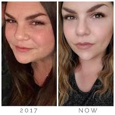 Acne treatment results with lymphatic cream