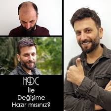 Saclariniza Kavusun Kendinizi Her Zaman Iyi Hissedin Hdc Ile Degisime Hazir Misiniz Nihatmugil Get Your Hair Back Always F Instagram Your Hair Kavu