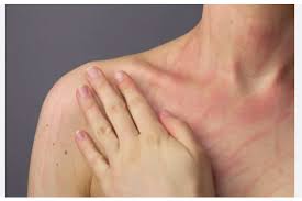 Image result for Dermatographism