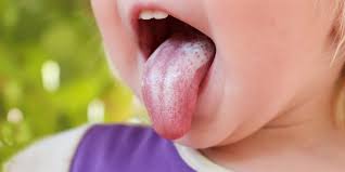 Image result for Oral thrush roof of mouth