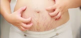 Image result for pruritic urticarial papules and plaques of pregnancy