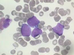 Hodgkin lymphoma is distinguished from the other types of lymphomas by the way it looks under a microscope and by the way it grows and spreads. University Of Southampton New Experimental Drug In Certain Patients With Diffuse Large B Cell Lymphoma Europawire Eu The European Union S Press Release Distribution Newswire Service