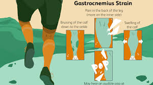 What is the anatomical term for your calf muscle of the lower leg. Medial Gastrocnemius Strain Overview And Treatment
