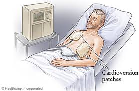 Image result for Synchronized Cardioversion