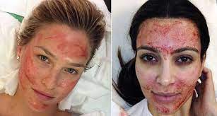 جلسة فراكشنال ليزر للوجه تجربتي قبل وبعد بشرة وشعر microneedling with prp microneedling glowing skin