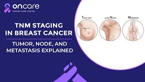 Image result for Breast Cancer Staging