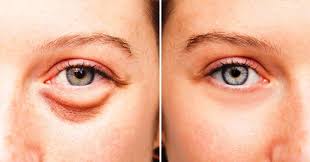 Baggy Or Puffy Eyes Are Something That You Do Not Want To See In The Mirror When You Wake Up In The Morning But Unfor Baggy Eyes Puffy Eyes Eye Care