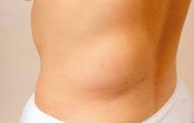 Puting payudara tertarik ke dalam. Bengkakan Lemak Pada Kulit Dr Zubaidi Hj Ahmad Menulis