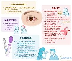 Image result for Conjunctivitis Resources