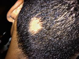 Your style of hair can cause hair loss when your hair is arranged in ways that pull on your roots, like tight ponytails, braids, or corn rows. Alopecia Hair Loss Patch
