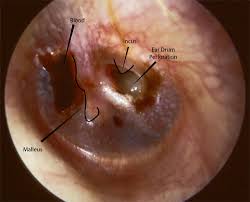 An eardrum that ruptures usually causes no pain, but it can be uncomfortable. Ear Trauma Images Mcgovern Medical School