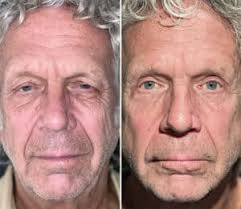 Droopy Eyelids Stole His Vision