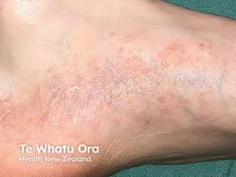 Image result for pompholyx soles of feet