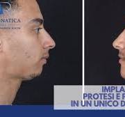 IMPLATE: il dispositivo innovativo per modificare il profilo ...
