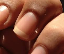 Чому часто виникають задирки на пальцях рук, як лікувати, як прибрати