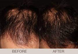 Non Surgical Hair Loss Treatment Bergen County Paramus Ridgewood Englewood Passaic Nj