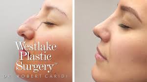 This woman had a bump on her dorsum, and her tip was overprojected, slightly bulbous and droopy. Nose Job Before And After Transformation Rhinoplasty Surgical Footage Youtube