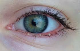 Gerstenkörner sind schmerzhafte entzündungen und schwellungen am oder im augenlid, die aussehen wie das korn der getreideart gerste. Entzundung Am Unteren Augenlid Geht Einfach Nicht Weg Augen Angeschwollen Gerstenkorn