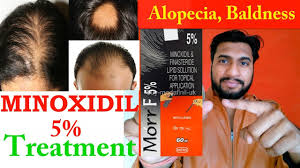 Dermatologist approved free shipping india. Hair Baldness Treatment By Morr F 5 Minoxidil Treatment Of Alopecia Review In Hindi 2018 Youtube