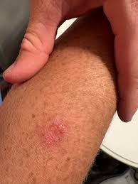 Image result for Spider Bite