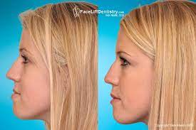 Check spelling or type a new query. Underbite Correction Without Surgery No Braces No Aligners