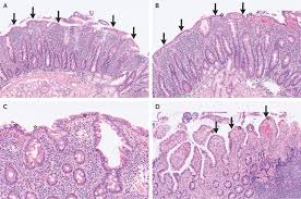Image result for Intestinal Enteropathy
