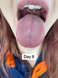 Image result for yellow tongue infection