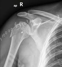 Anterior — the front of the shoulder. Irreducible Anterior Shoulder Dislocation With Interposition Of The Long Head Of The Biceps And Greater Tuberosity Fracture A Case Report And Review Of The Literature