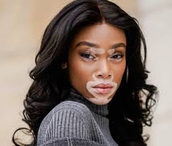Image result for Vitiligo