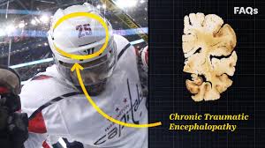 Ceza i̇nfaz kurumları i̇le tutukevleri i̇şyurtları kurumu. Cte Why This Brain Disease Is More Common Than You Think Youtube