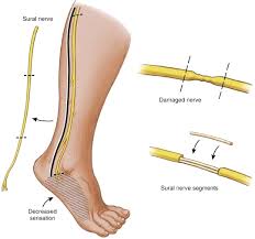 Image result for Peripheral Neuropathy