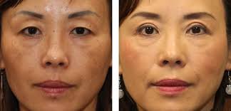 By sagging of the eyebrows, then a forehead (brow) lift may be recommended. Before After Asian Eyelid Surgery Photos Asian Blepharoplasty Pictures