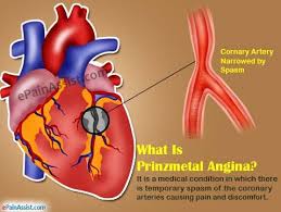 Pin On Chest Pain