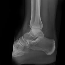 It contains codes for diseases, signs and symptoms, abnormal findings, complaints. Ankle Fracture Wikidoc