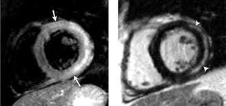 Eine spezielle mrt des herzens, kann krankhafte veränderungen ohne röntgenstrahlen sichtbar machen, die mit anderen methoden nicht zu sehen sind. T2 Weighted Cardiovascular Magnetic Resonance Imaging Abdel Aty 2007 Journal Of Magnetic Resonance Imaging Wiley Online Library