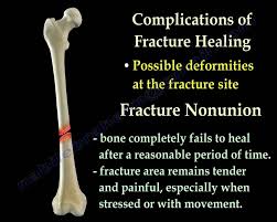 Image result for Fracture Complication