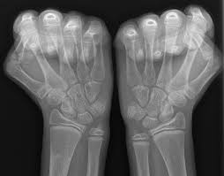 Bilyard masalarının istehsalında yalnız bir sıra təbii. Orto Nu Tfcc Skada