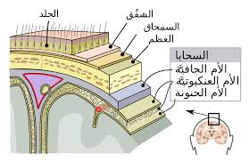 التهاب السحايا ويكيبيديا