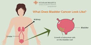 One of the most common signs of bladder cancer is blood in the urine. Bladder Cancer Why Blood In Urine Is A Cause Of Concern